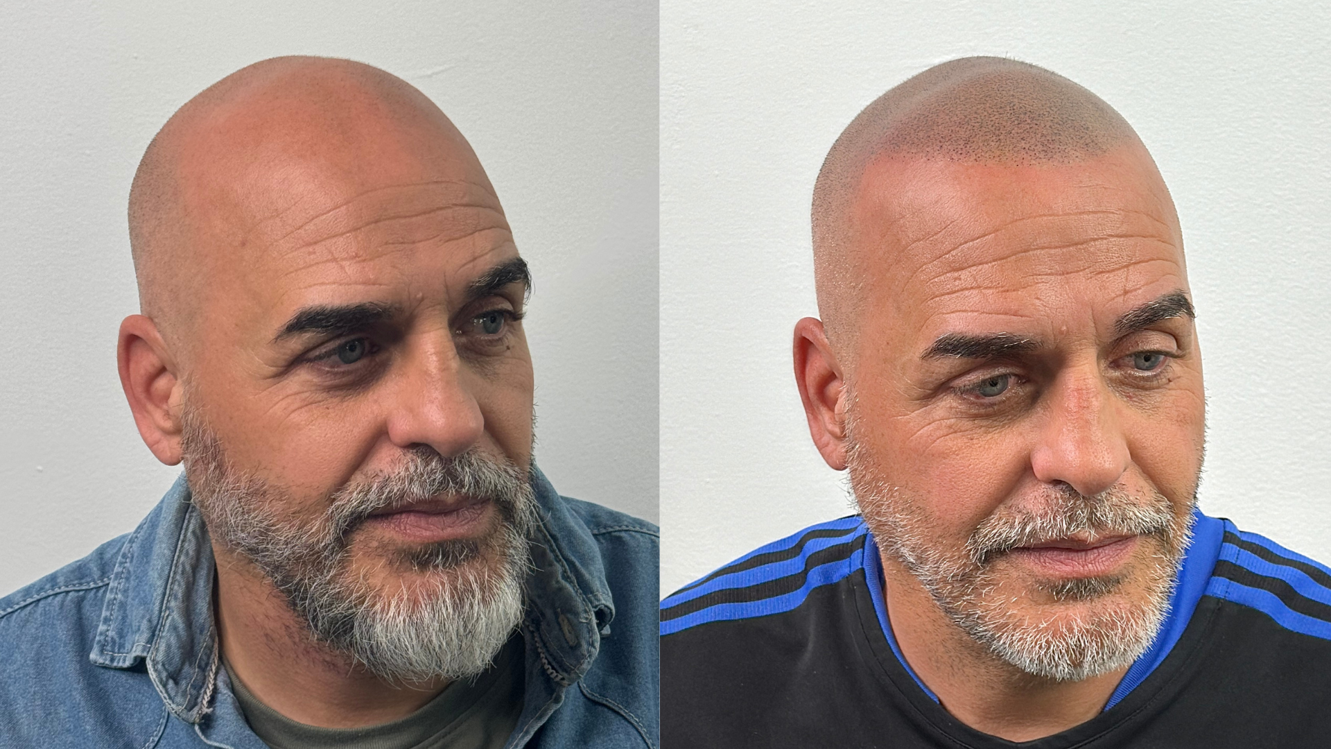 Antes y después micropigmentación capilar — caso 1