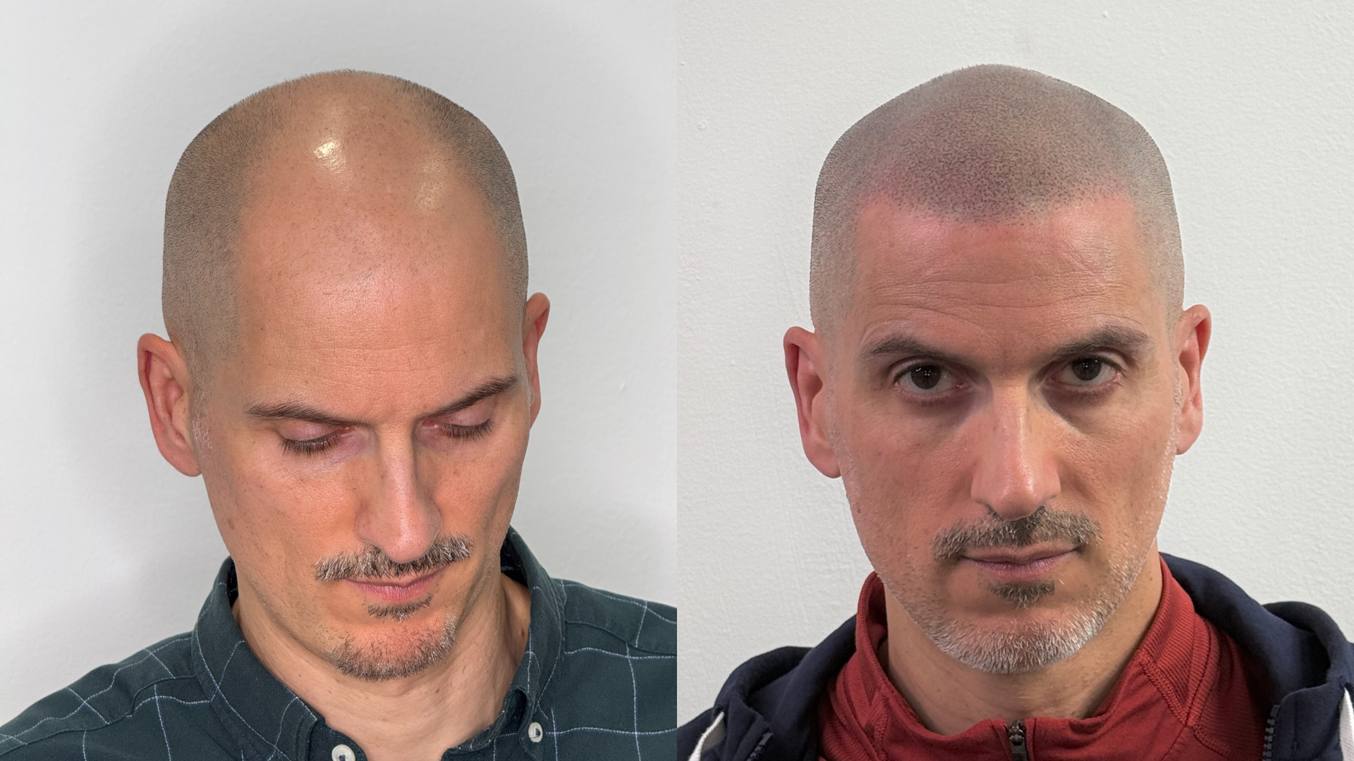 Antes y después micropigmentación capilar — caso 3