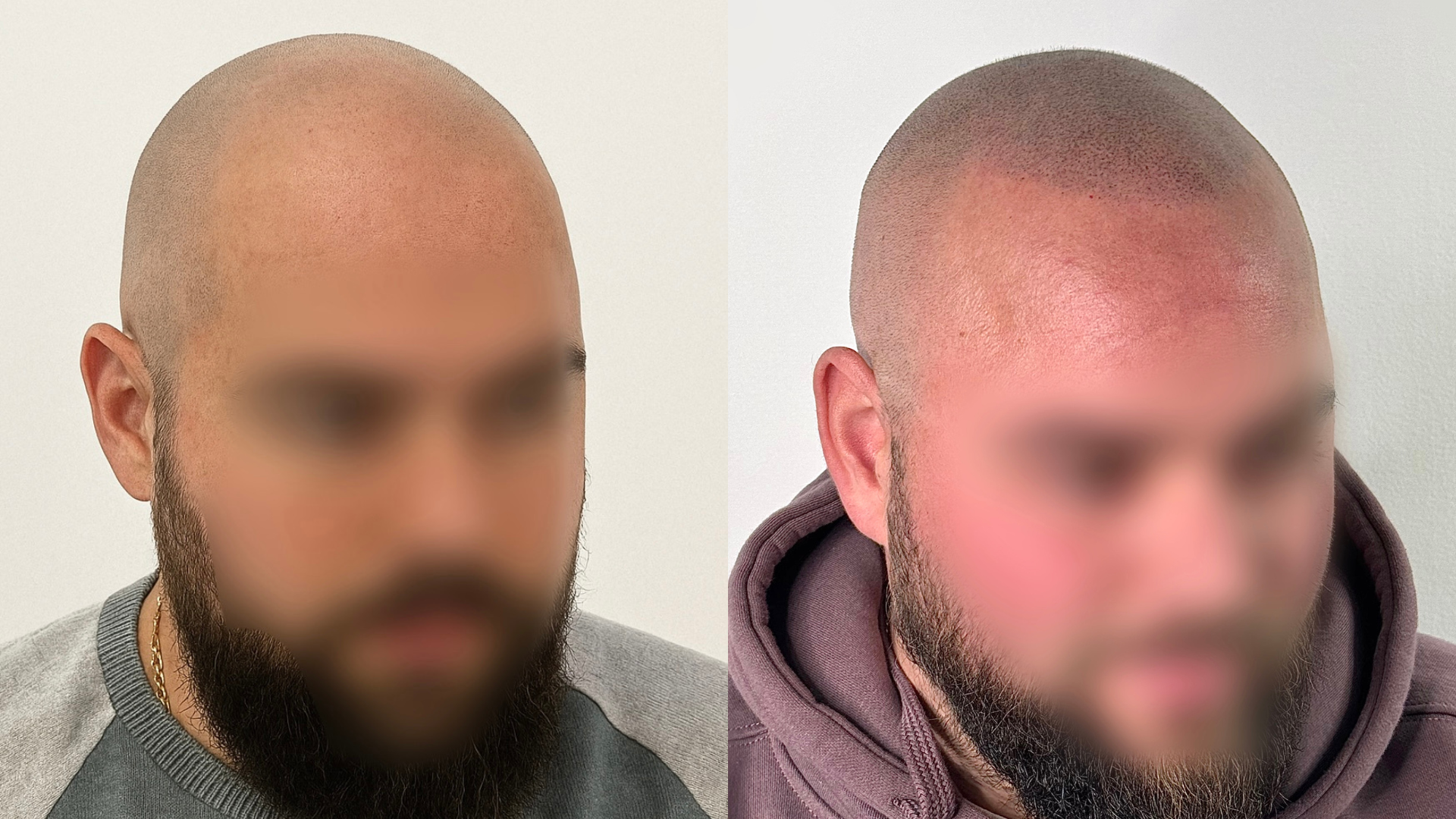 Antes y después micropigmentación capilar — caso 4