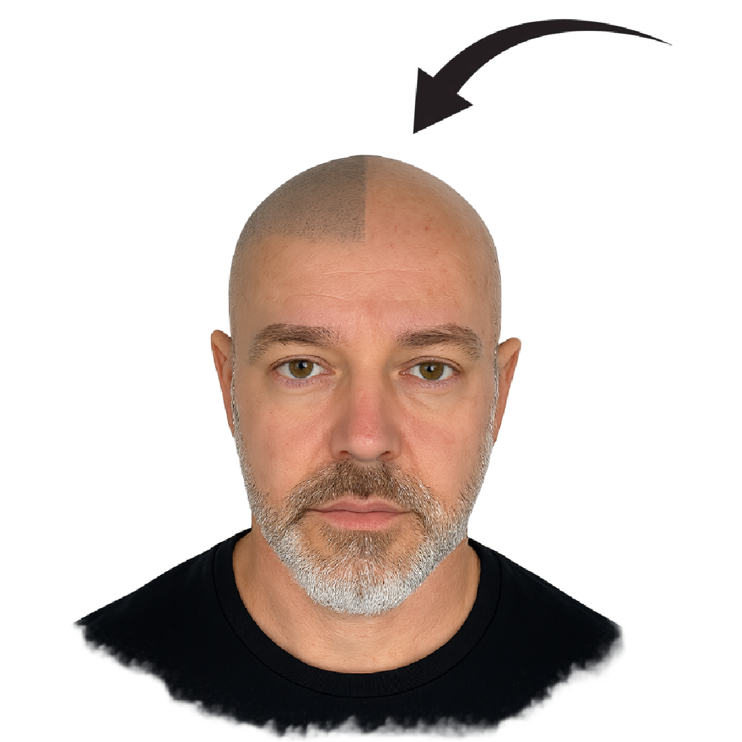 Resultado micropigmentación capilar — antes y después